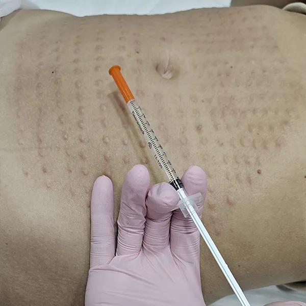 Intradermoterapia
